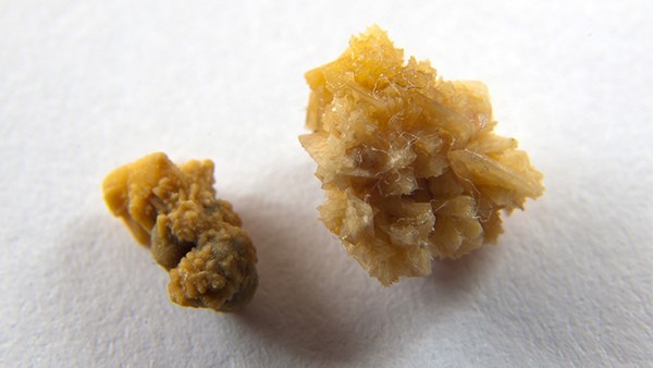 尿路上皮癌的药物治疗方法