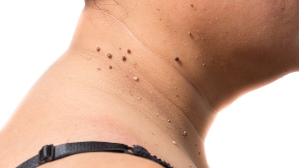 胰腺神经内分泌瘤的实验性治疗