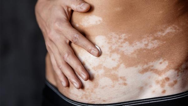 消化不良是否需要吃抗生素