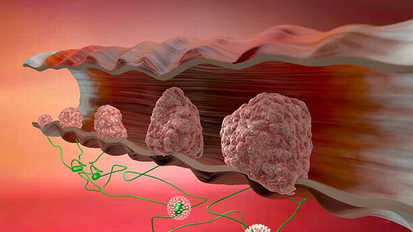 脊髓小脑共济失调的症状